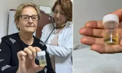 Antalya’da 4 yıl önce akciğerine kaçan hap bronkoskopiyle çıkarıldı