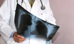 Uzman uyardı: Zatürrede erken tanı hayat kurtarıyor