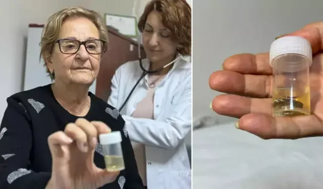 Antalya’da 4 yıl önce akciğerine kaçan hap bronkoskopiyle çıkarıldı