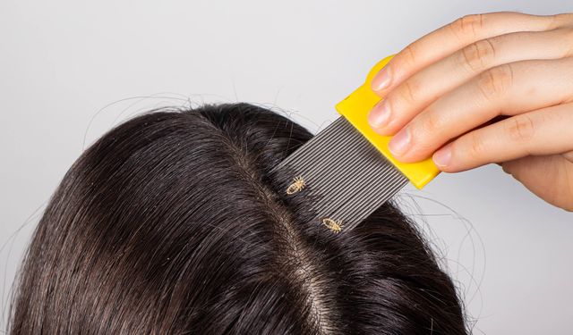 Saç biti neden olur, nasıl geçer?