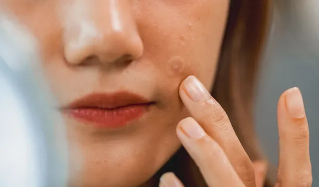 Sivilceyi sıkmak neden en büyük hata? Akne gerçekleri