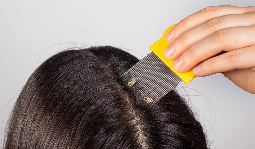 Saç biti neden olur, nasıl geçer?